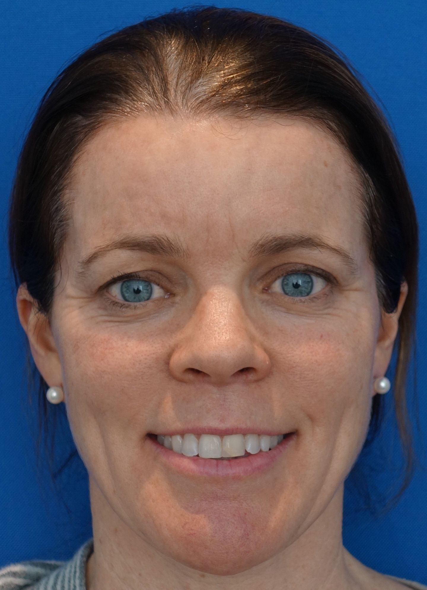 Botox smile pre crop