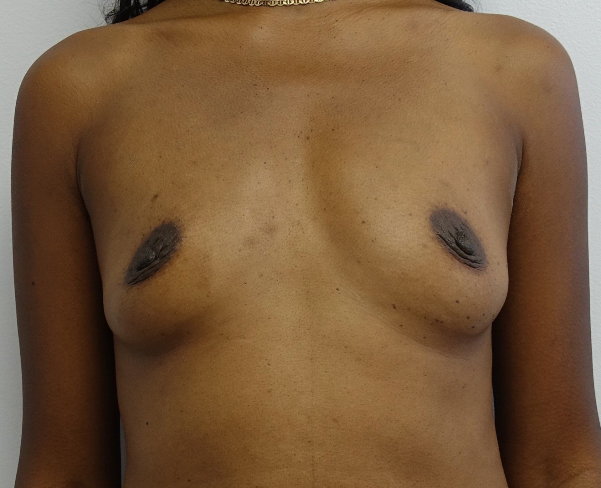 Breast augmentation pre cropped 1