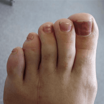 Claw Toes Burrowing 4th toe corrected