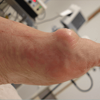 Arthritic Big Toe Joint