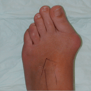 Bunion Severe bunion pre surgery
