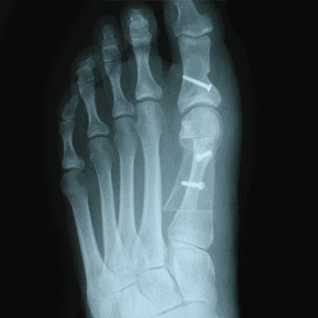 Bunion Post surgery