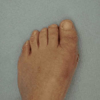 Bunion Bunion 2 weeks post surgery