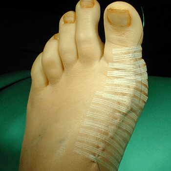 Bunion Severe bunion post