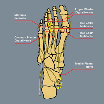 Diagram of Morton's neuroma