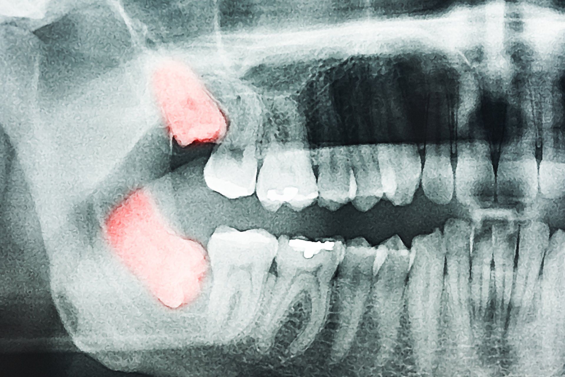 Wisdom Teeth Extraction X-Ray