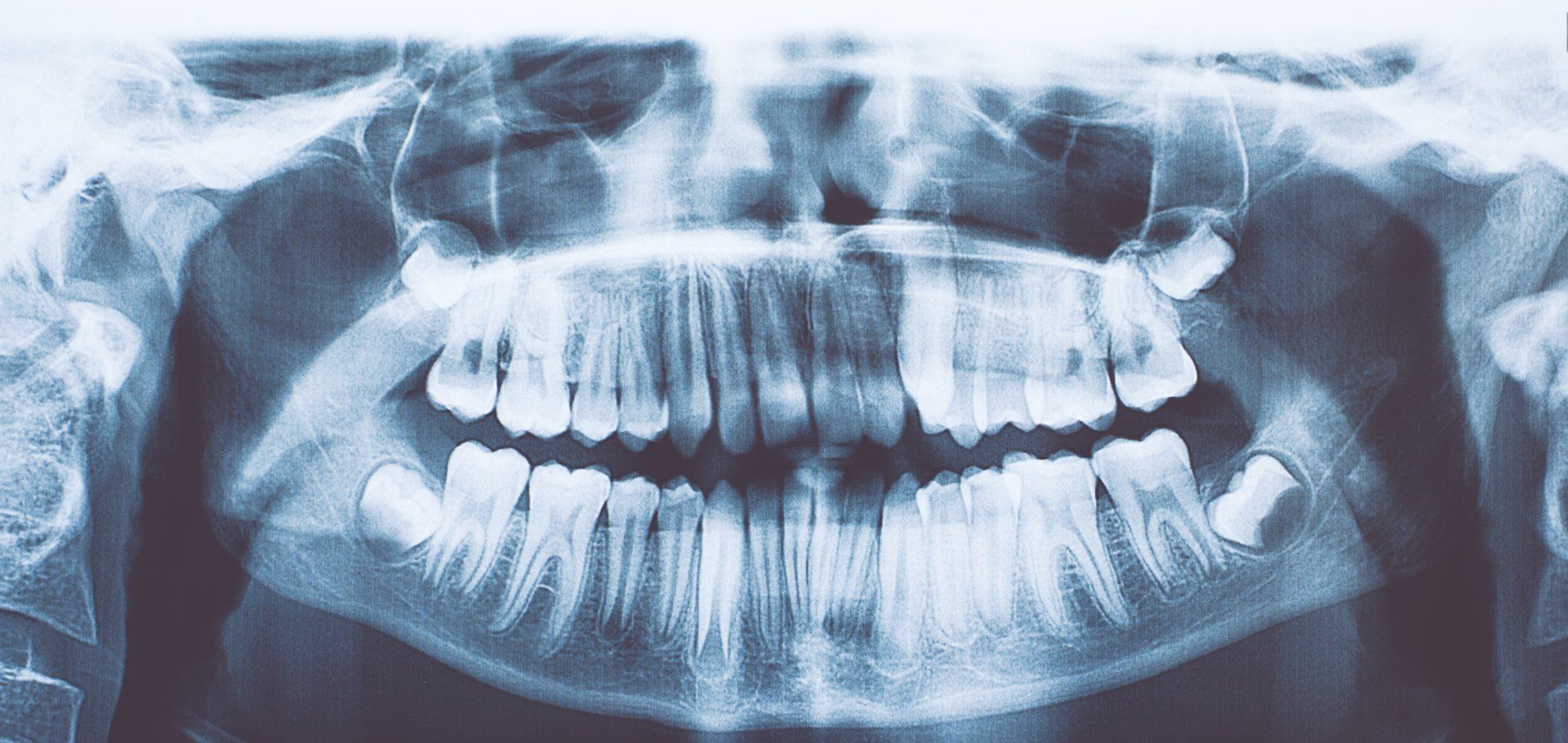 Root Canal X-Ray