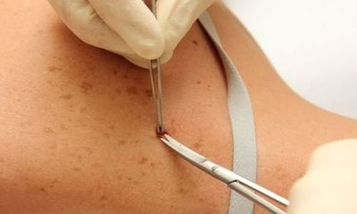 Unas manos enguantadas retiran una sutura cutánea con un instrumento médico.