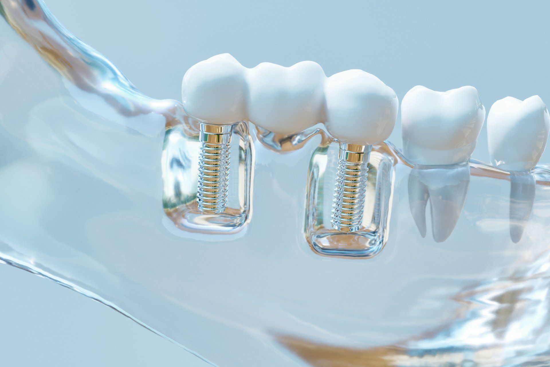 Dental Implants — Wilmington, NC — Sandra Miles Dentistry Dental Implants — Wilmington, NC — Sandra Miles Dentistry