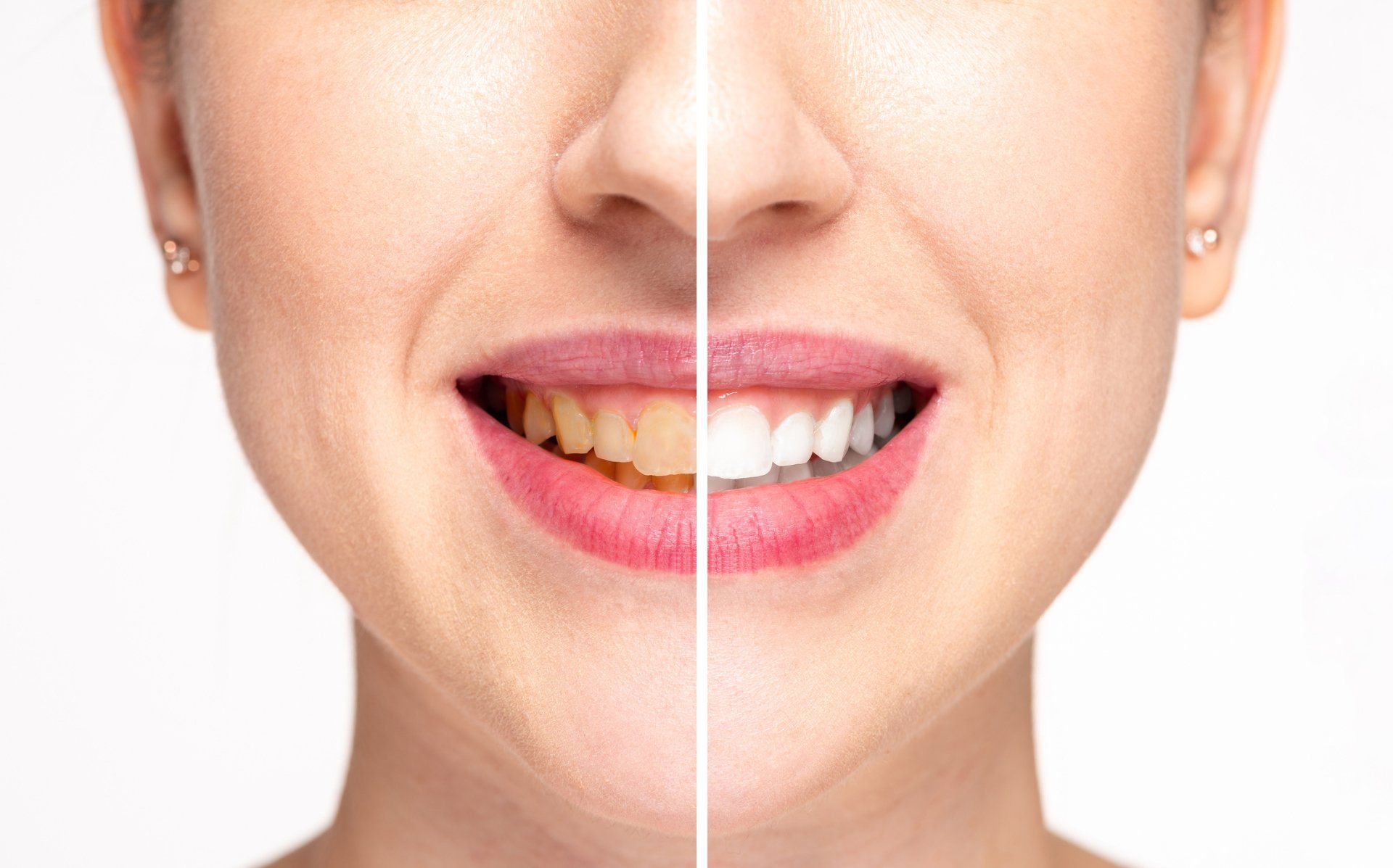 Teeth Whitening — Wilmington, NC — Sandra Miles Dentistry Teeth Whitening — Wilmington, NC — Sandra Miles Dentistry