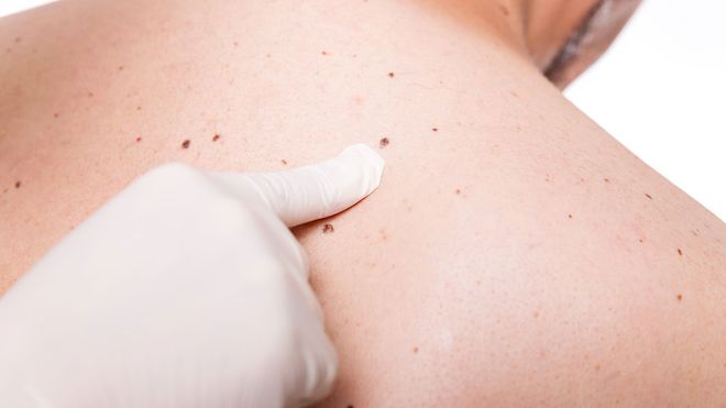 Skin Cancer Treatment