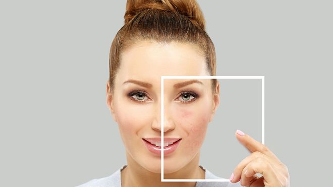 Rosacea Treatment
