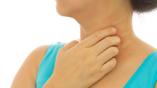ECZEMA Treatment