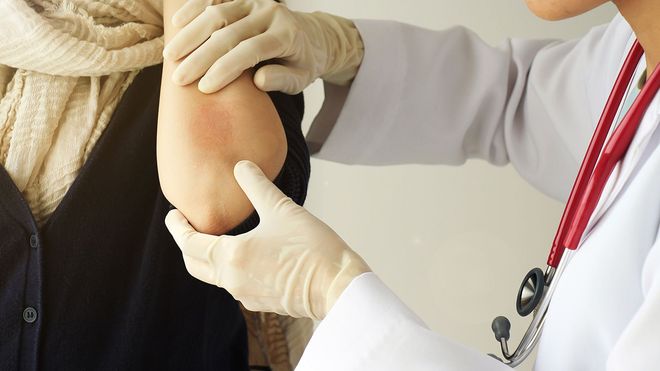 Psoriasis Treatment
