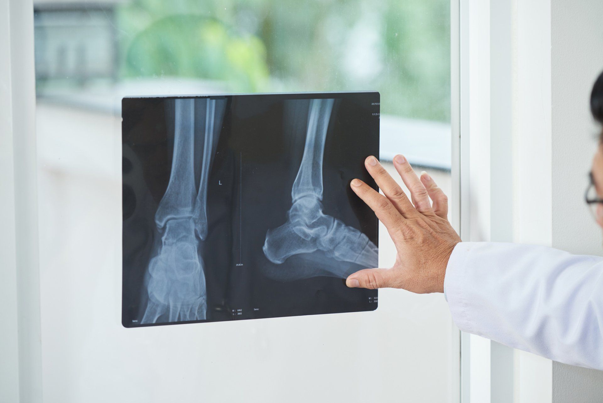 Foot Fractures — Garden City, NY — Megan Chapter D.O.