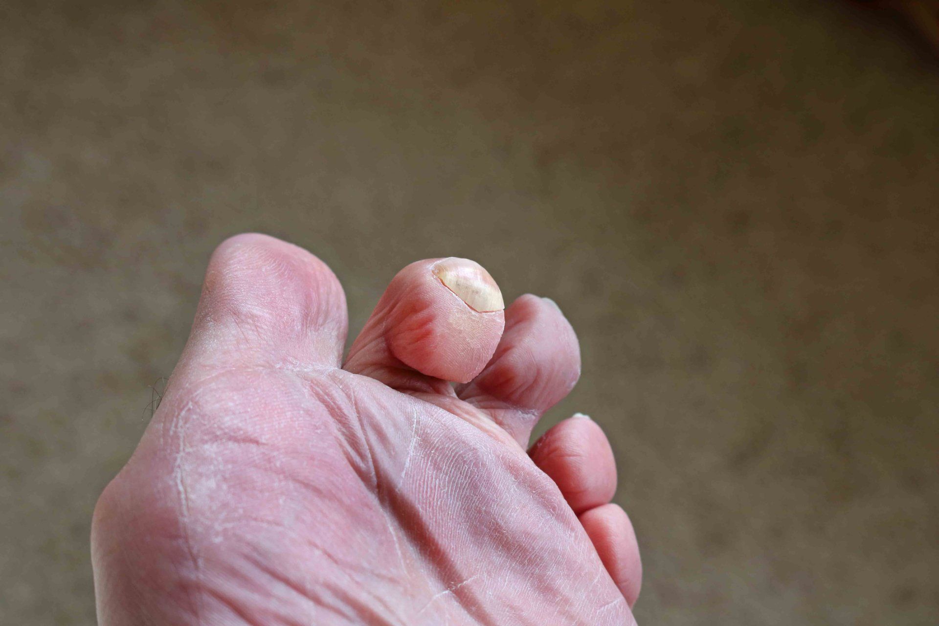 Claw & Hammer Toe Deformities — Garden City, NY — Megan Chapter D.O.