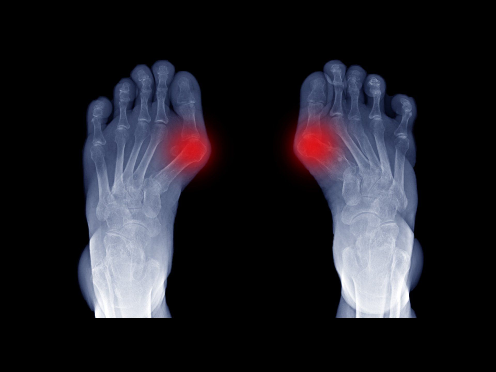 Bunions — Garden City, NY — Megan Chapter D.O.
