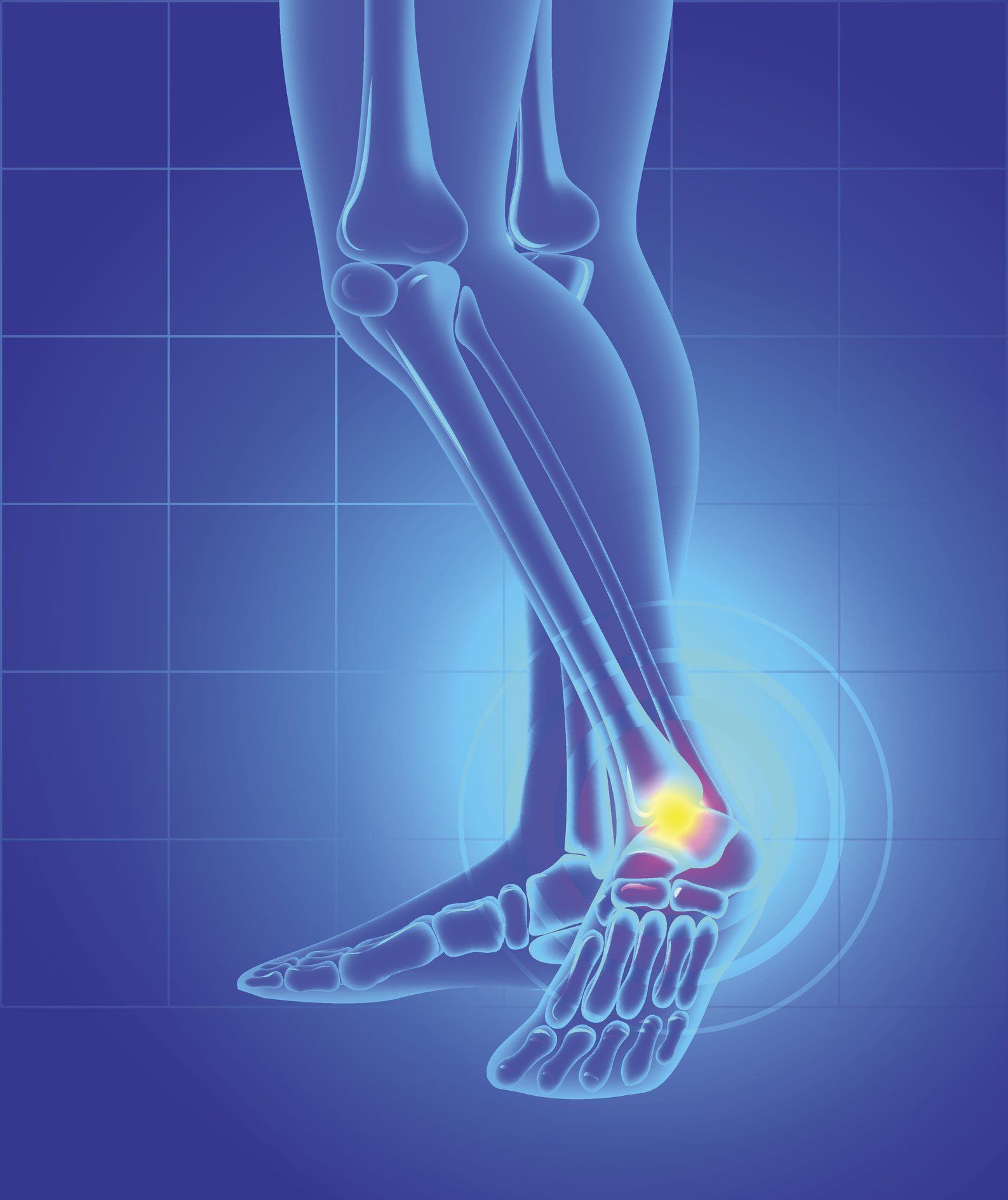 Ankle Cartilage Injury — Garden City, NY — Megan Chapter D.O.