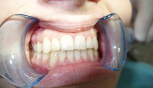 Big smile, lips apart and teeth together.