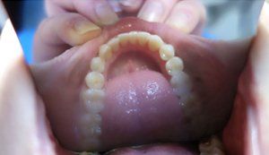 Mouth wide open, teeth wide apart, with picture taken from above to