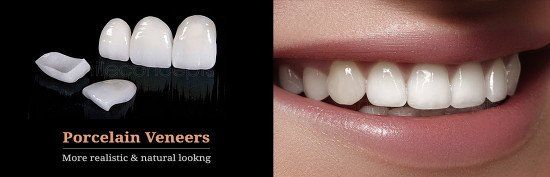 Porcelain Veneers - More realistic & Natural Looking
