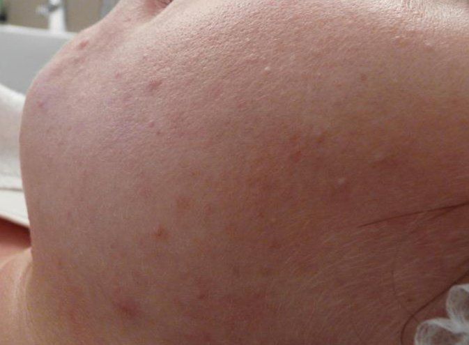 Nahaufnahme des Gesichts einer Person mit Akne nach der Behandlung. Die Haut ist kaum gerötet, die Hautstrucktur ist sehr eben, es sind nur wenige einzelne Pickel zu sehen.