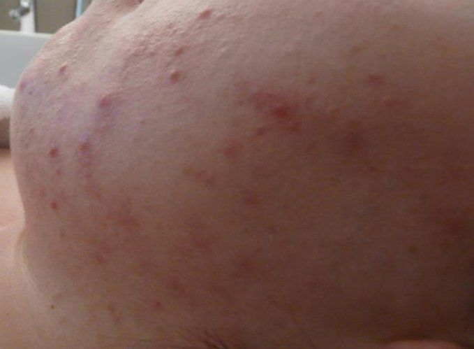 Nahaufnahme des Gesichts einer Person, auf deren Haut Akne zu sehen ist. Die Haut ist sehr uneben durch viele gerötete Pickel.