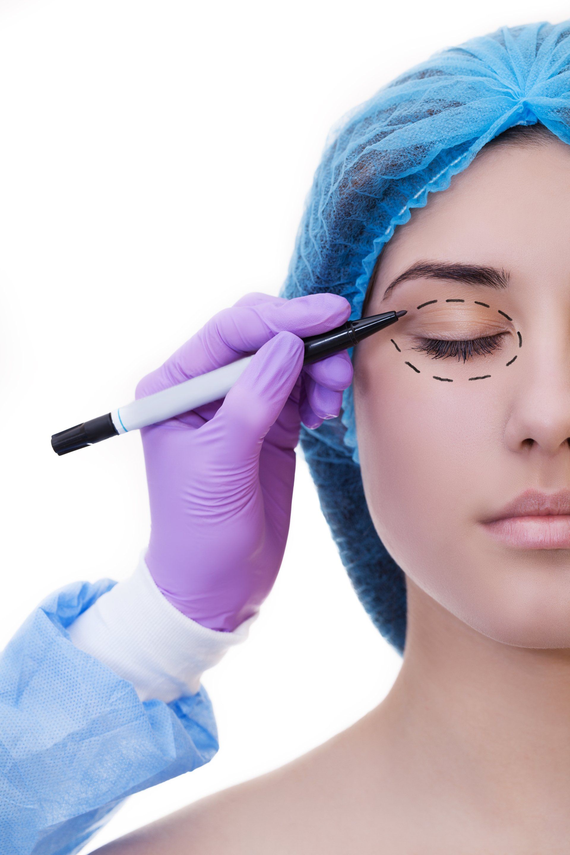 Blefaroplastia Blefaroplastia