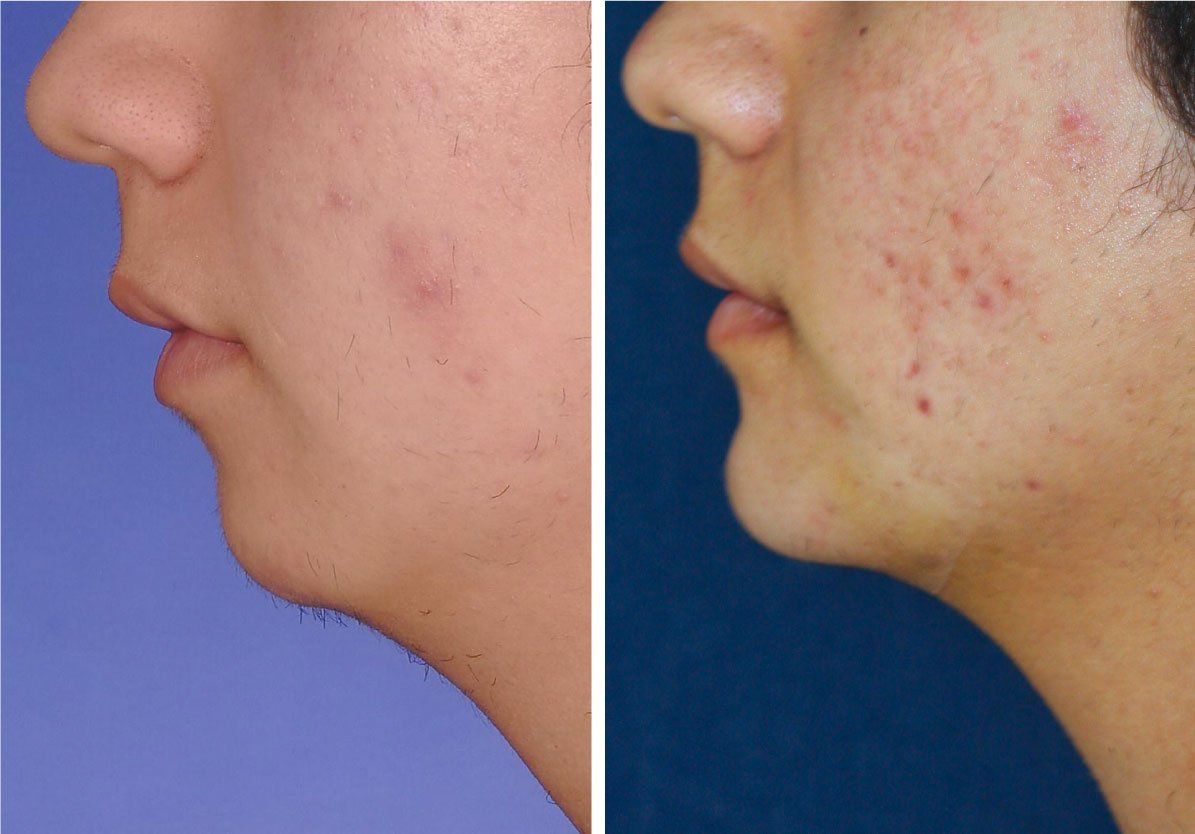 Mentoplastia