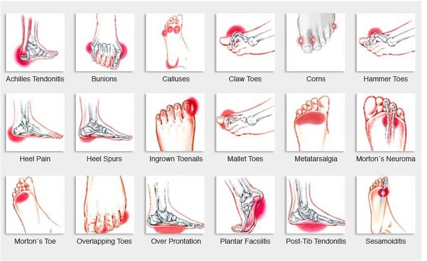 Foot Conditions — Laser Therapy in Kingscliff, NSW Foot Conditions — Laser Therapy in Kingscliff, NSW