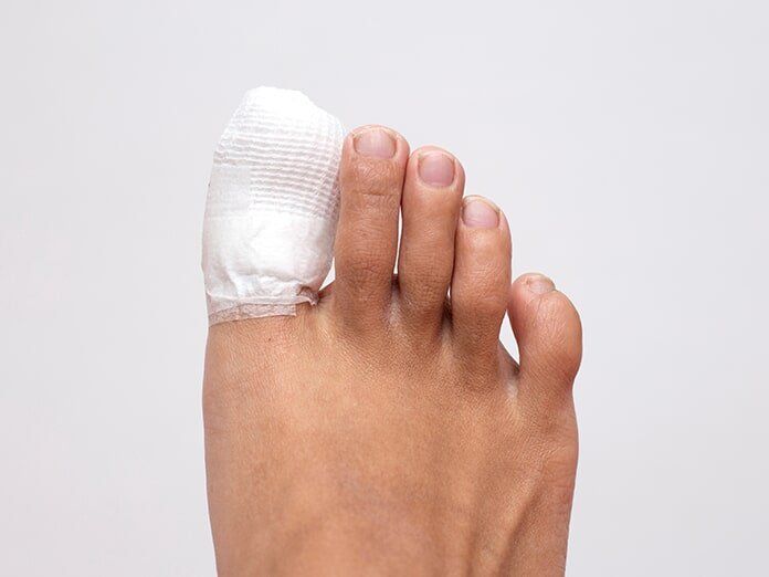 Nail Surgery — Podiatrist Kingscliff, NSW