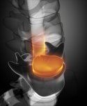 Herniated Disc