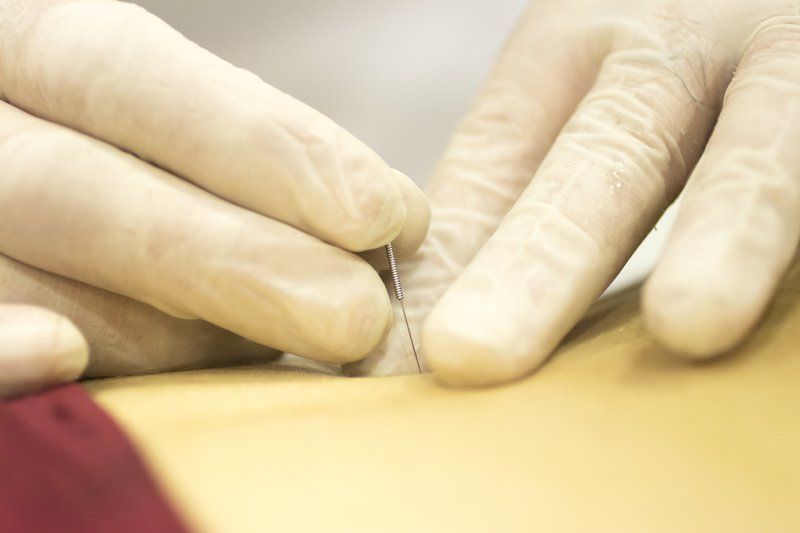 Dry Needling