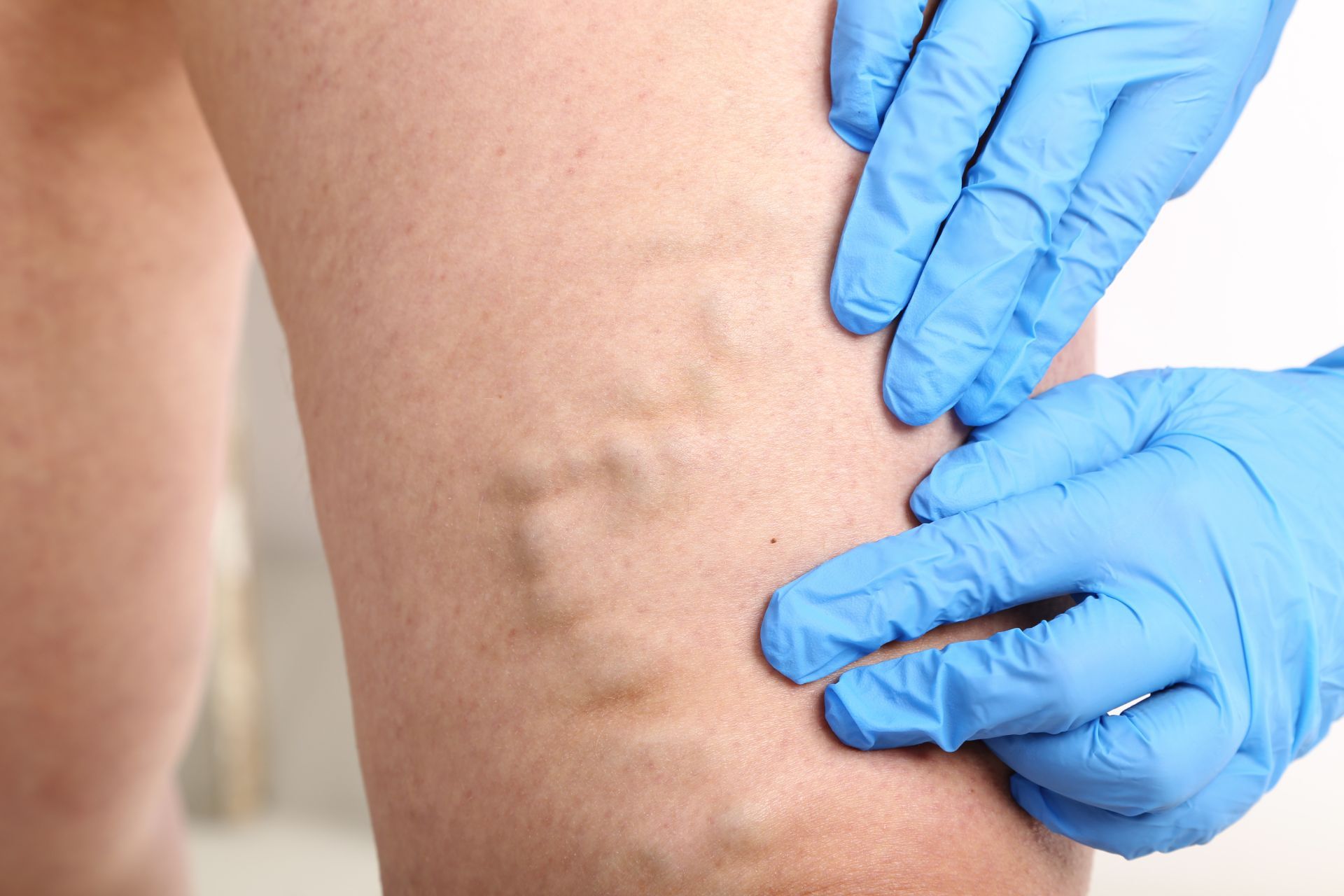 Vein Sclerotherapy