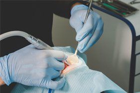dental restoration