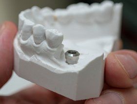dental implant