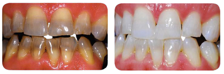kor teeth whitening offered at Dental Innovations in Wasilla AK