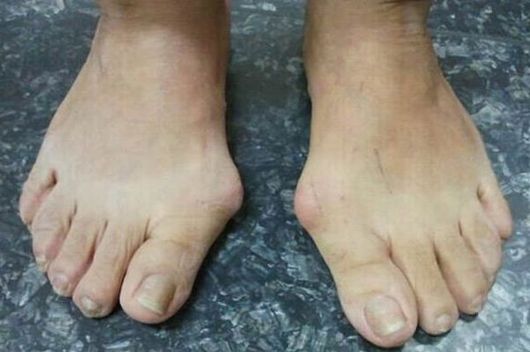 feet with growths