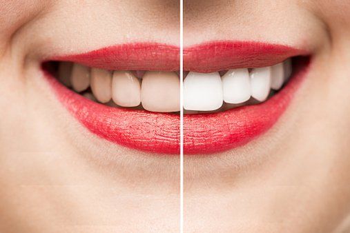 Teeth Before & After Whitening - Teeth Whitening in Worth, IL
