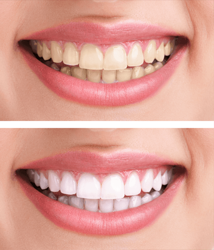 Revitalise your teeth