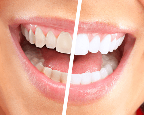 How white will my teeth go?