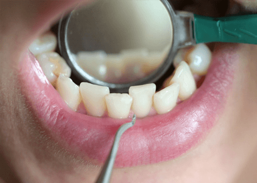 Veneers