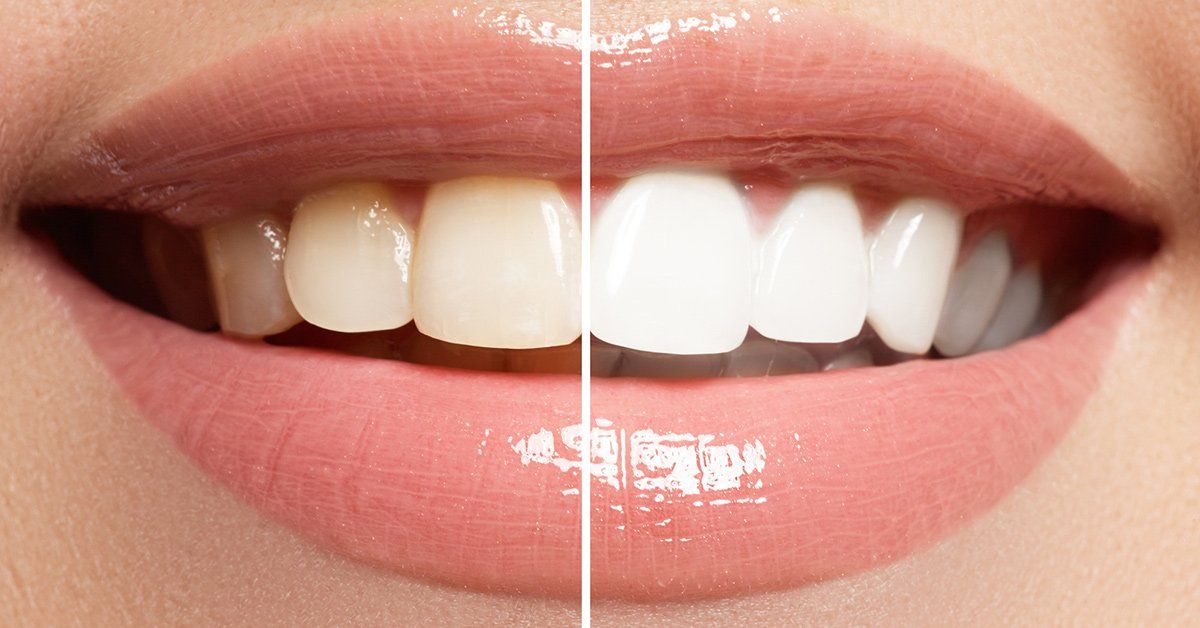 teeth whitening