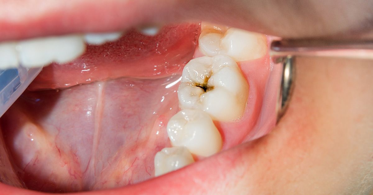 how to prevent cavities