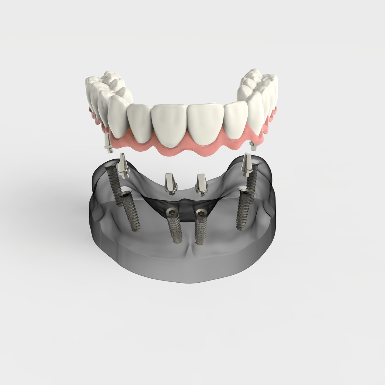 Tooth Replacement — Cary & Garner, NC — Cusumano Oral Surgery & Implant Center Image representing teeth restoration surgery in Cary, NC