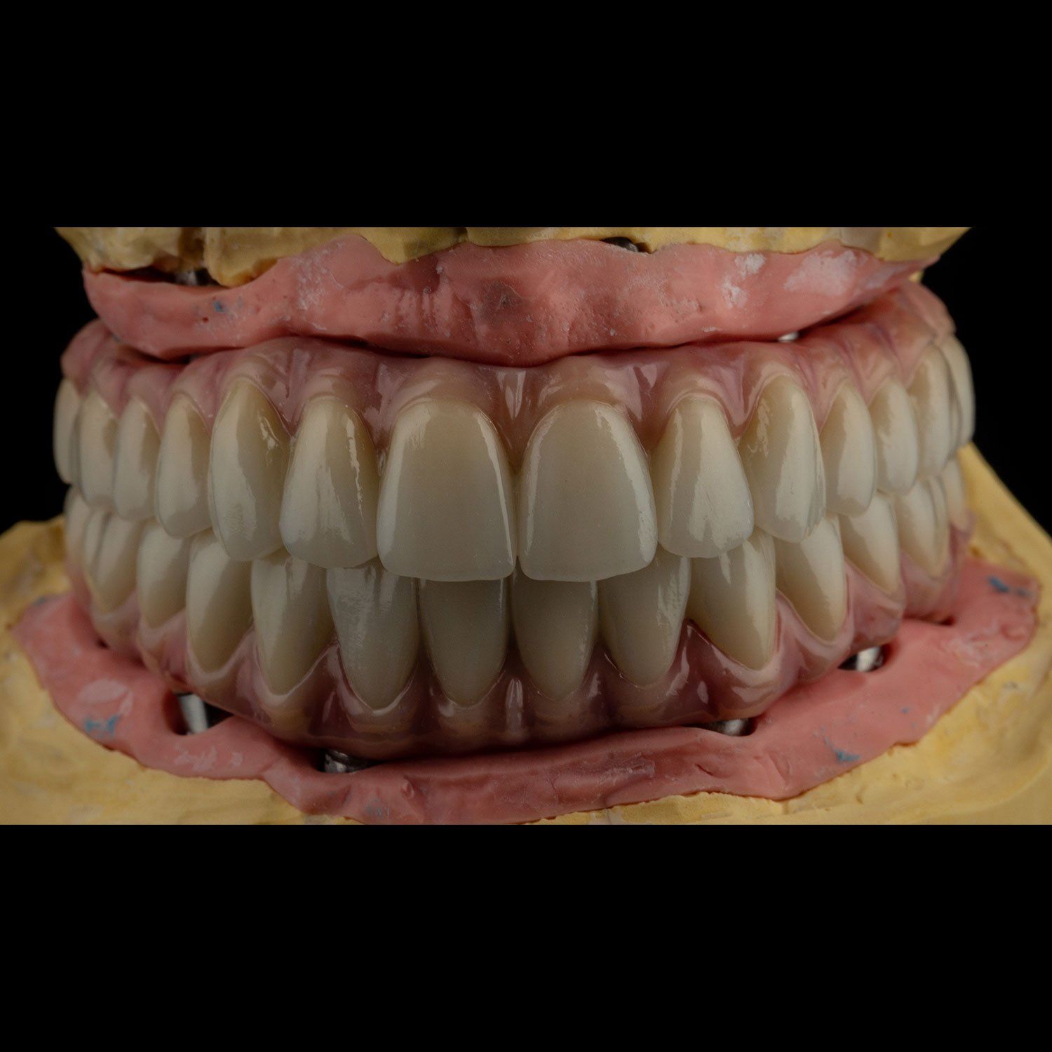 Tooth Replacement — Cary & Garner, NC — Cusumano Oral Surgery & Implant Center Tooth Replacement — Cary & Garner, NC — Cusumano Oral Surgery & Implant Center