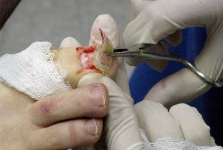 ingrown toenail