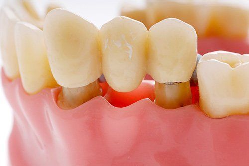 Dental Bridge Dental Bridge | Dental Implants Endicott