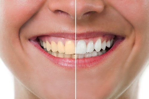 Teeth Whitening Teeth whitening comparison