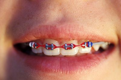 traditional braces - Cosmetic Dentistry in West Chicago, IL